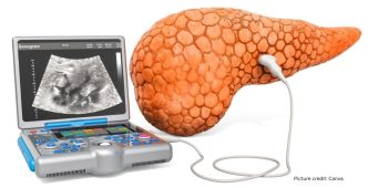 AI Model REDMOD Shows Promise in Early Detection of Pancreatic Cancer