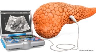 AI Model REDMOD Shows Promise in Early Detection of Pancreatic Cancer