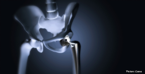 Surge in Hip Replacement Surgeries Among Younger Indians Attributed to Post-COVID Complications
