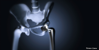 Surge in Hip Replacement Surgeries Among Younger Indians Attributed to Post-COVID Complications