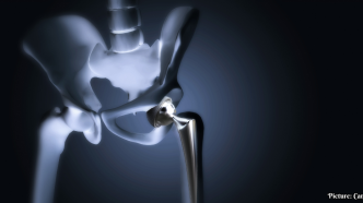Surge in Hip Replacement Surgeries Among Younger Indians Attributed to Post-COVID Complications