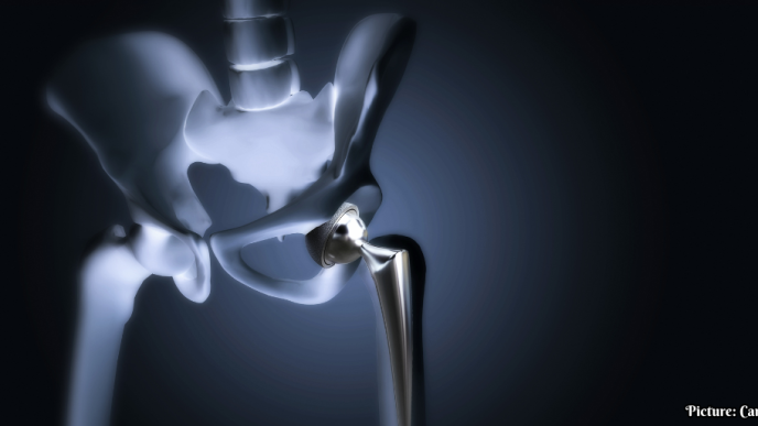 Surge in Hip Replacement Surgeries Among Younger Indians Attributed to Post-COVID Complications