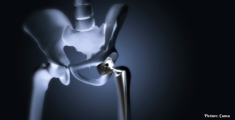 Surge in Hip Replacement Surgeries Among Younger Indians Attributed to Post-COVID Complications