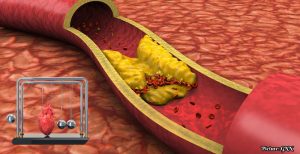 National Medical Organizations Issue Stricter Cholesterol Guidelines Lowering LDL Targets for Cardiovascular Prevention