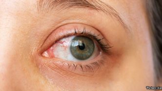 Increased Screen Time Linked to Rising Incidence of Dry Eye Syndrome