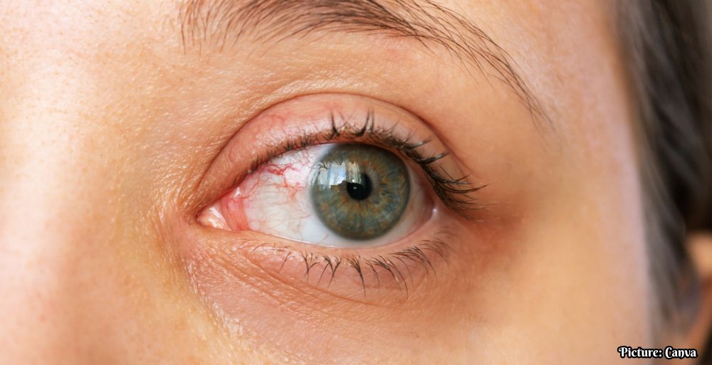 Increased Screen Time Linked to Rising Incidence of Dry Eye Syndrome