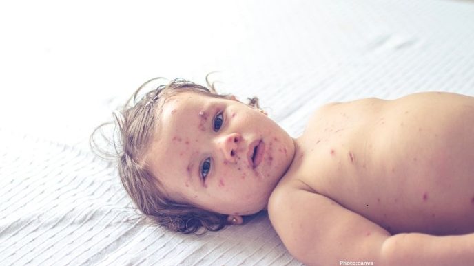United States Faces Surge in Measles Cases, Threatening Elimination Status