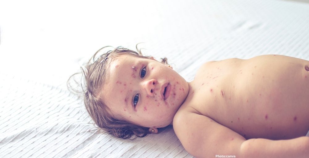 United States Faces Surge in Measles Cases, Threatening Elimination Status