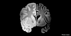 King's College London Study Links Long-Term Inflammation to Cognitive Decline