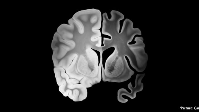 King's College London Study Links Long-Term Inflammation to Cognitive Decline