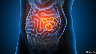 Understanding Chronic Inflammation: Causes, Effects, and Management